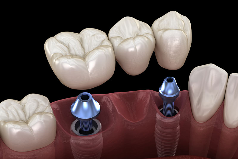 dental implant