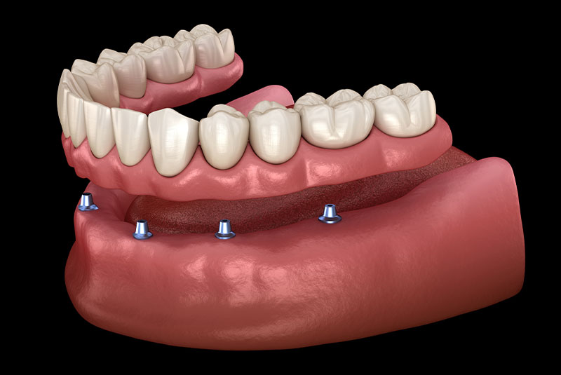 denture 3d
