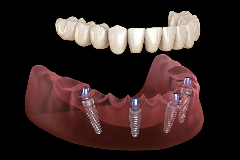 full arch 3d