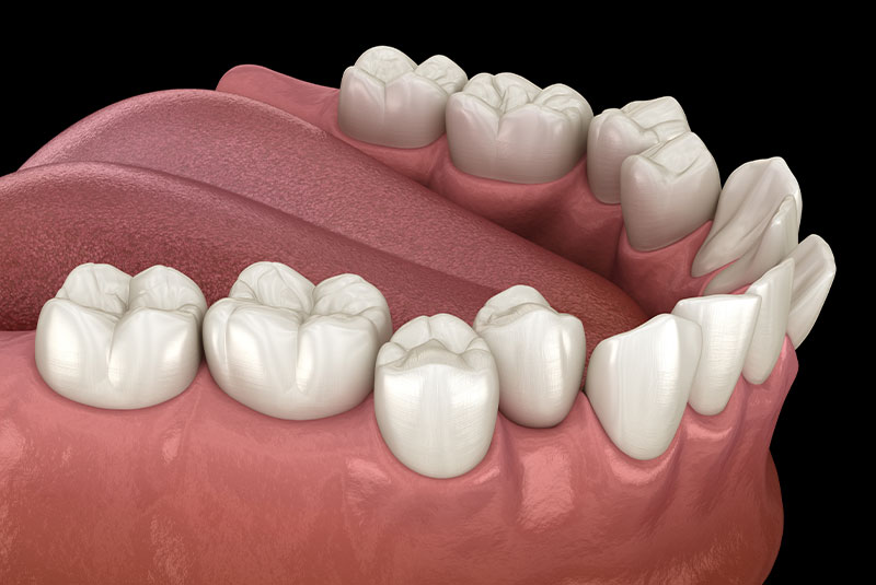 Misaligned teeth