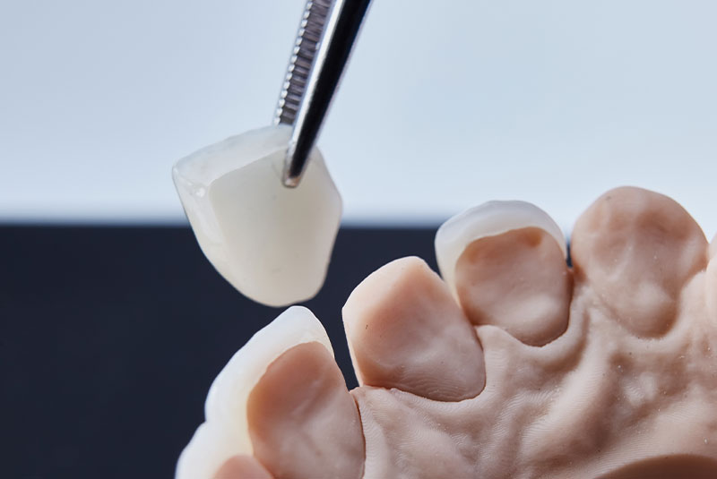 Porcelain Veneers